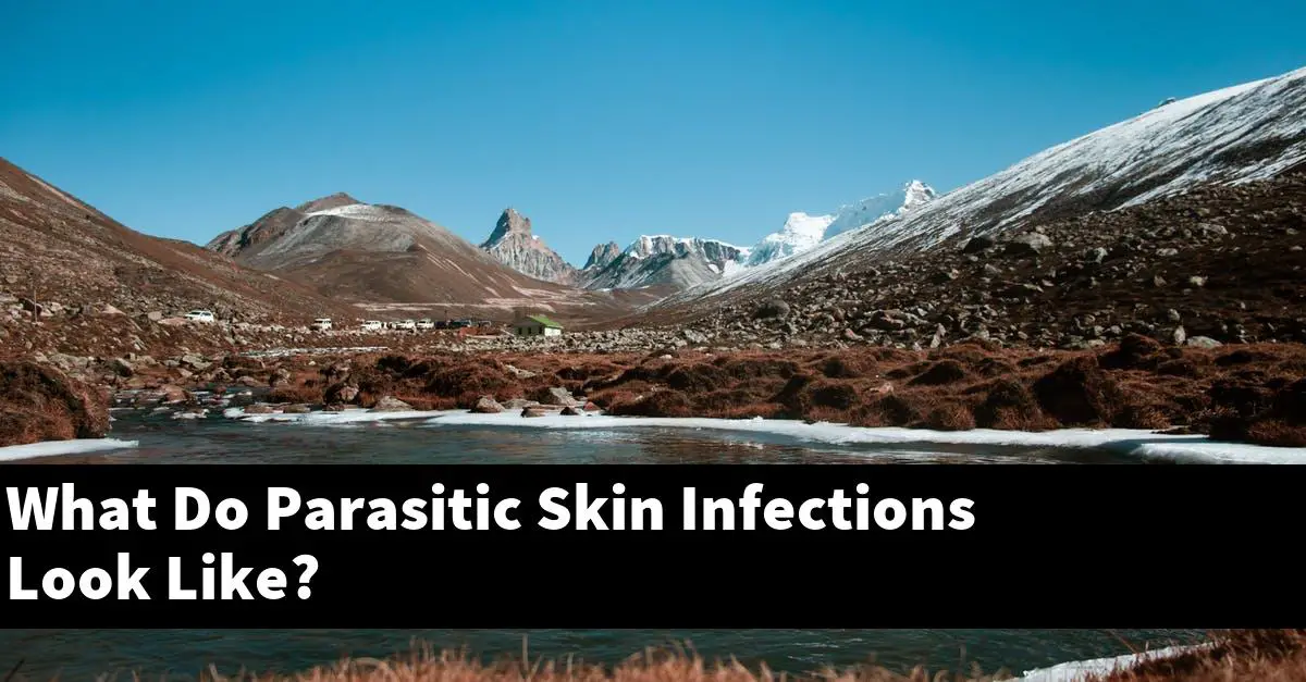 What Do Parasitic Skin Infections Look Like?