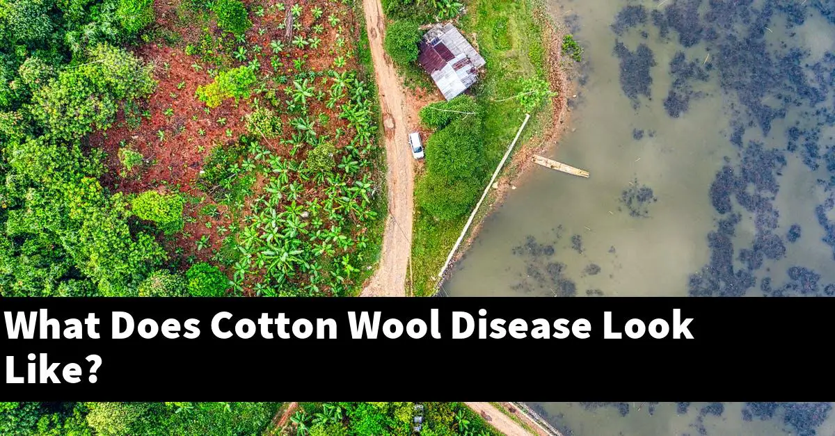 What Does Cotton Wool Disease Look Like?
